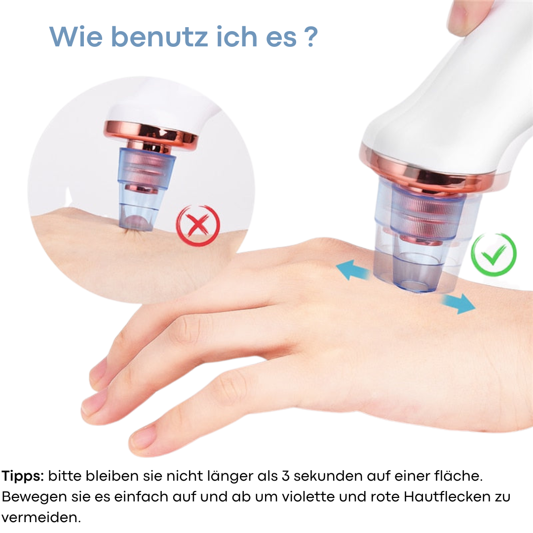 Mitesser Remover
